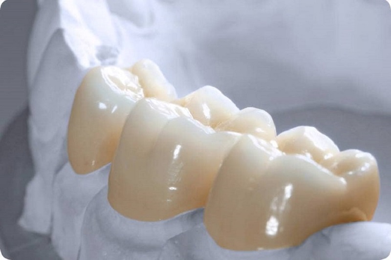 Ưu Điểm Của Răng Sứ Zirconia